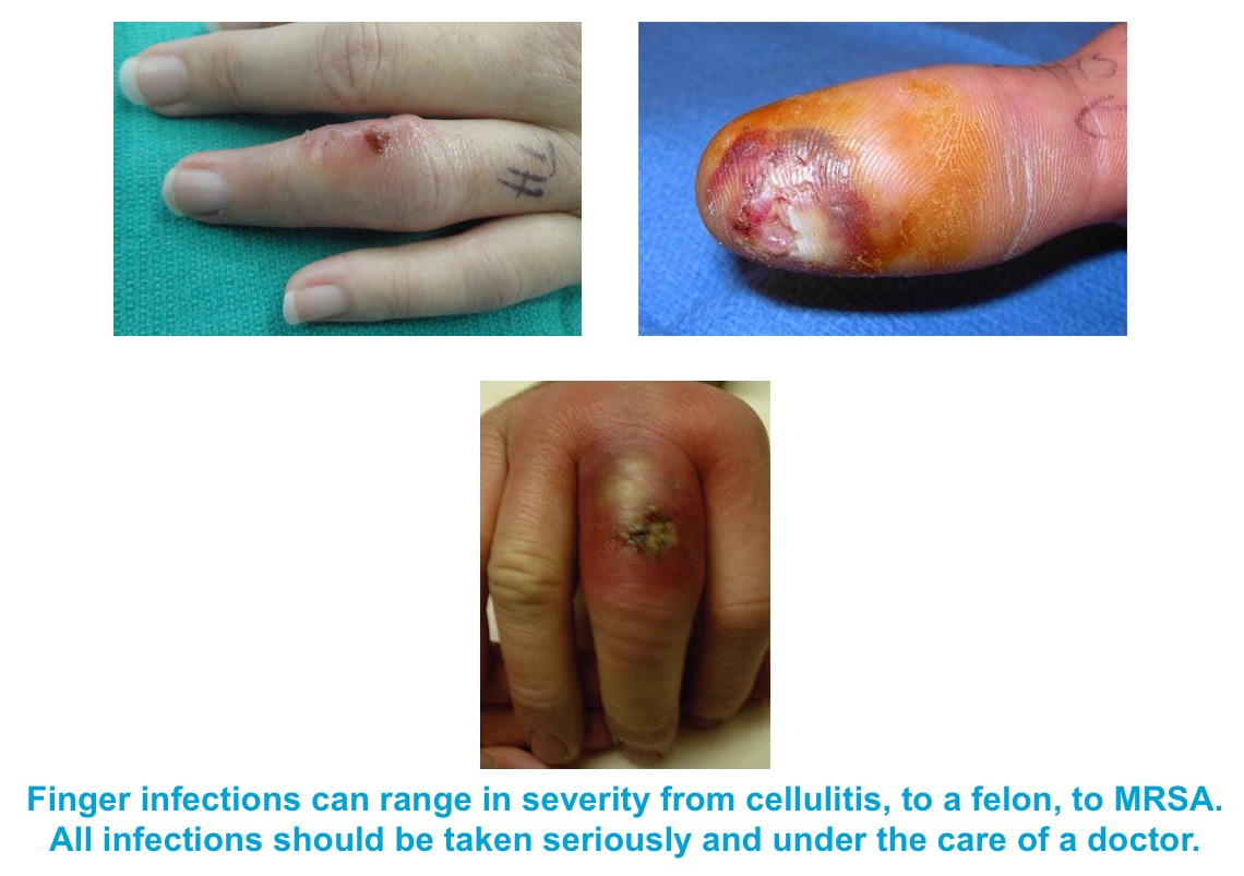 Hand Surgeon in Miami Beach