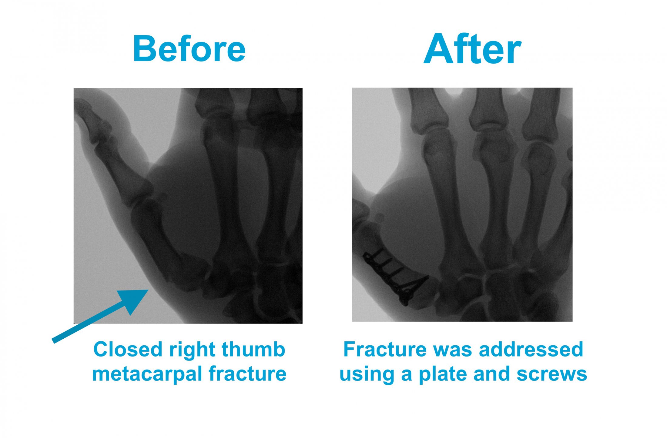 Hand Surgeon in Miami Beach